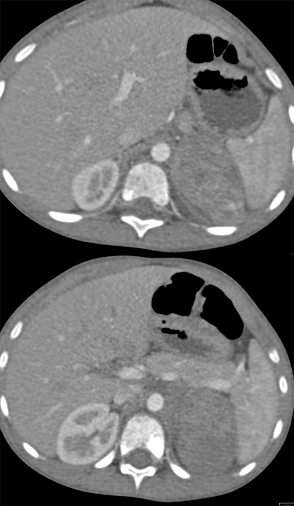 30 yr old with Back Pain