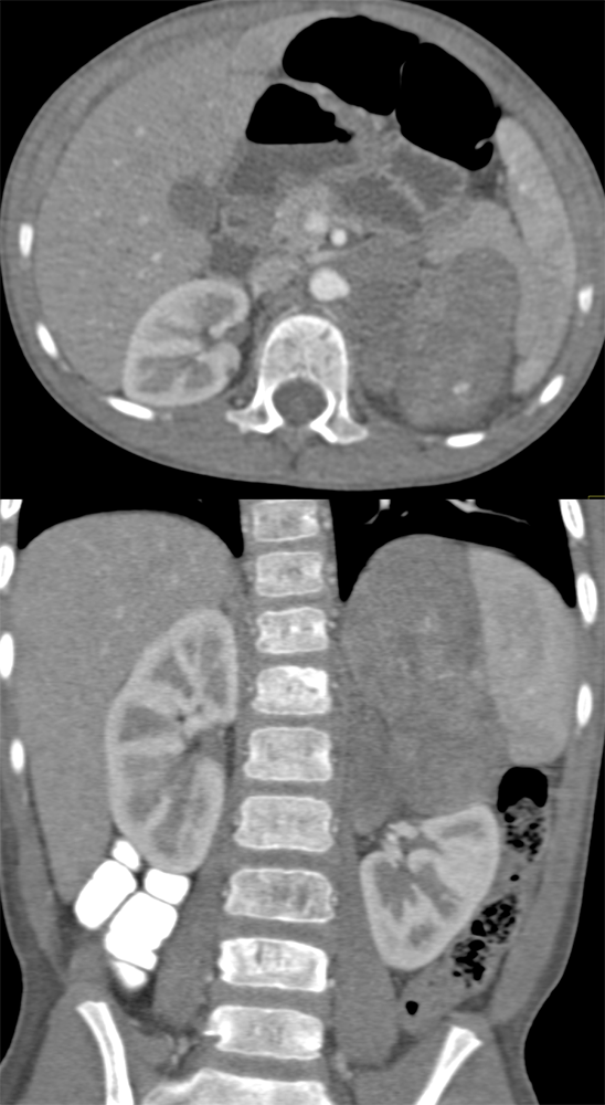 Large Adrenal Masses