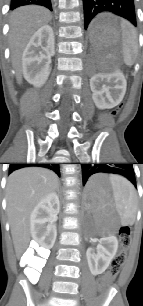 Large Adrenal Masses