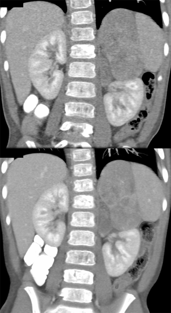 Large Adrenal Masses