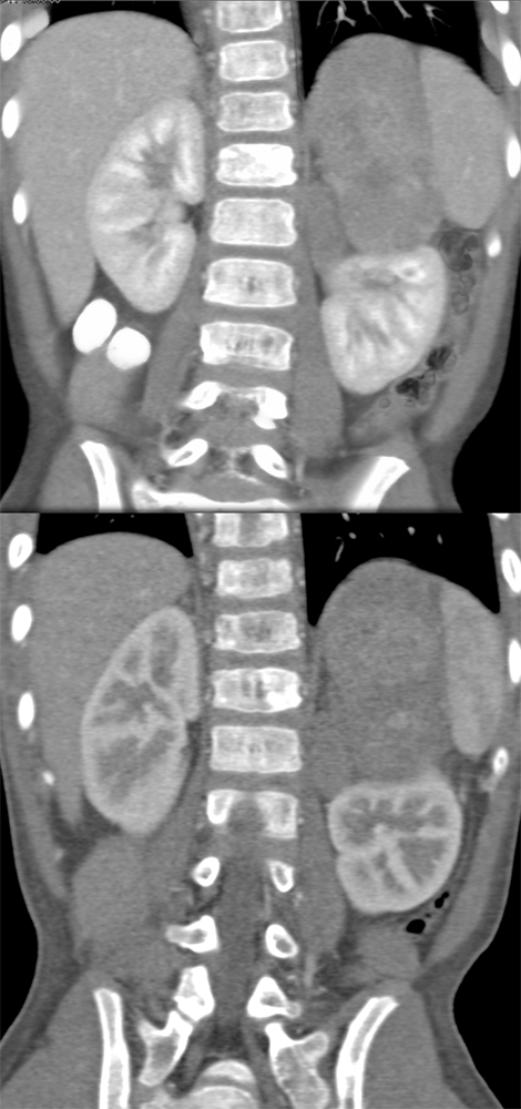 Large Adrenal Masses