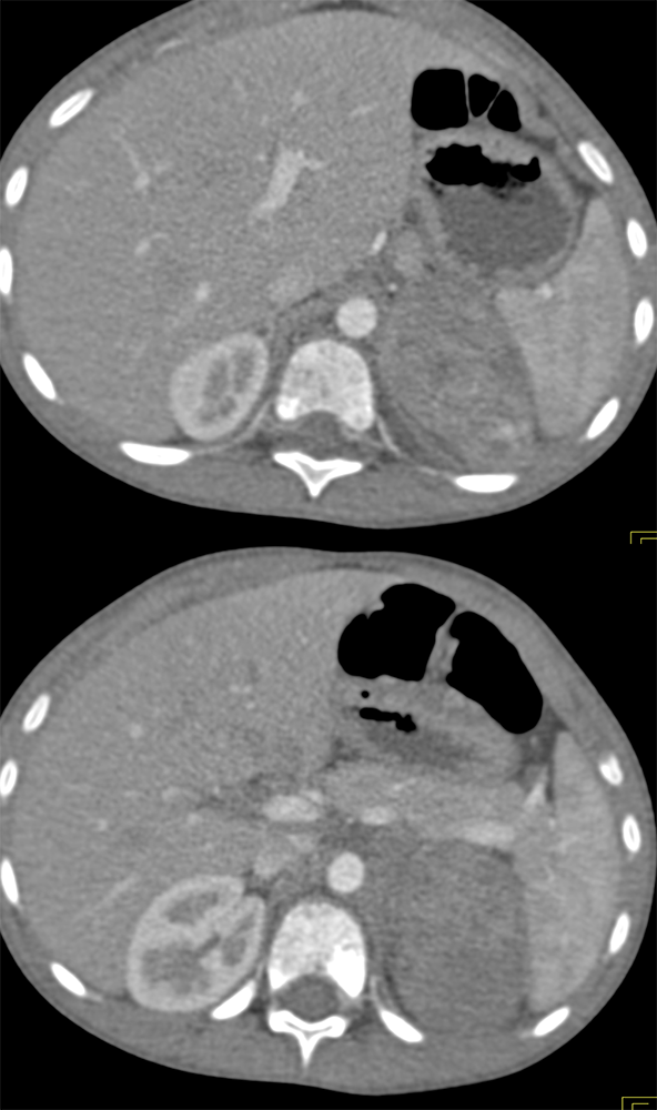 Neuroblastoma