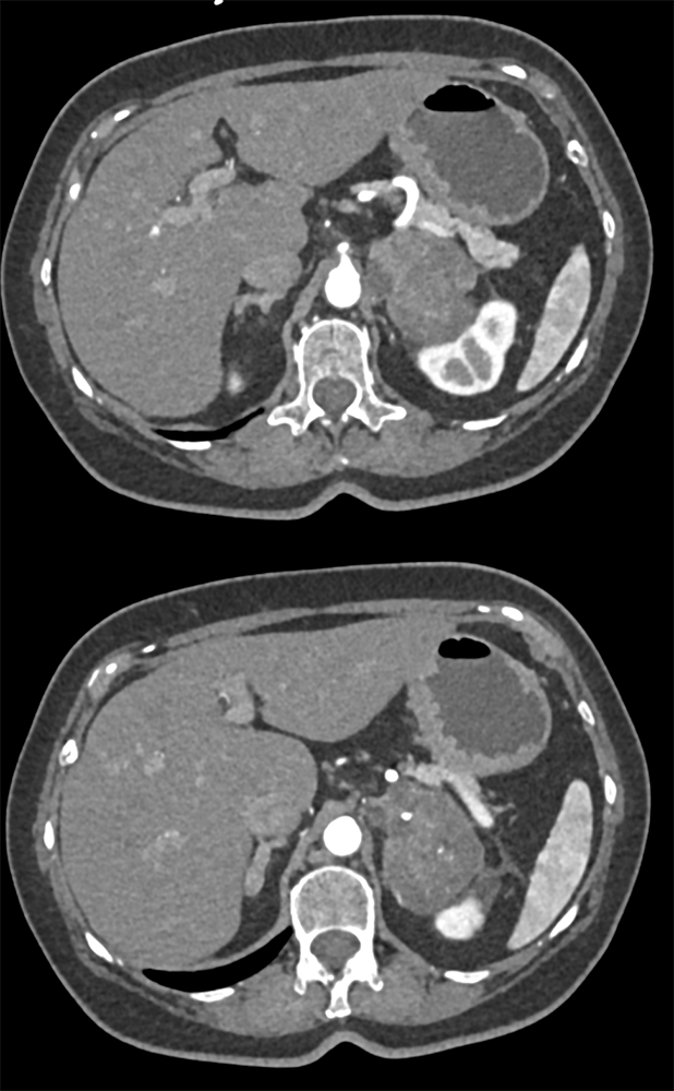 Evaluate pancreas mass (bx was neuroendocrine tumor)