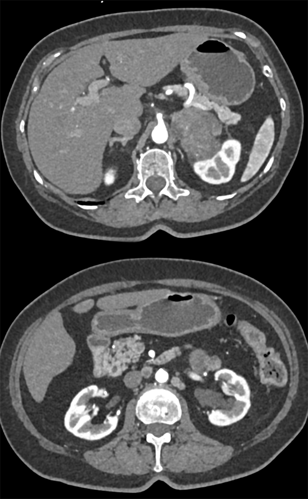 Large Adrenal Masses