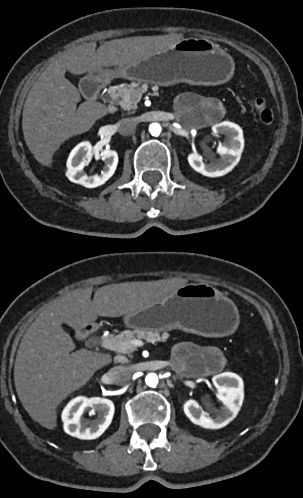 Large Adrenal Masses