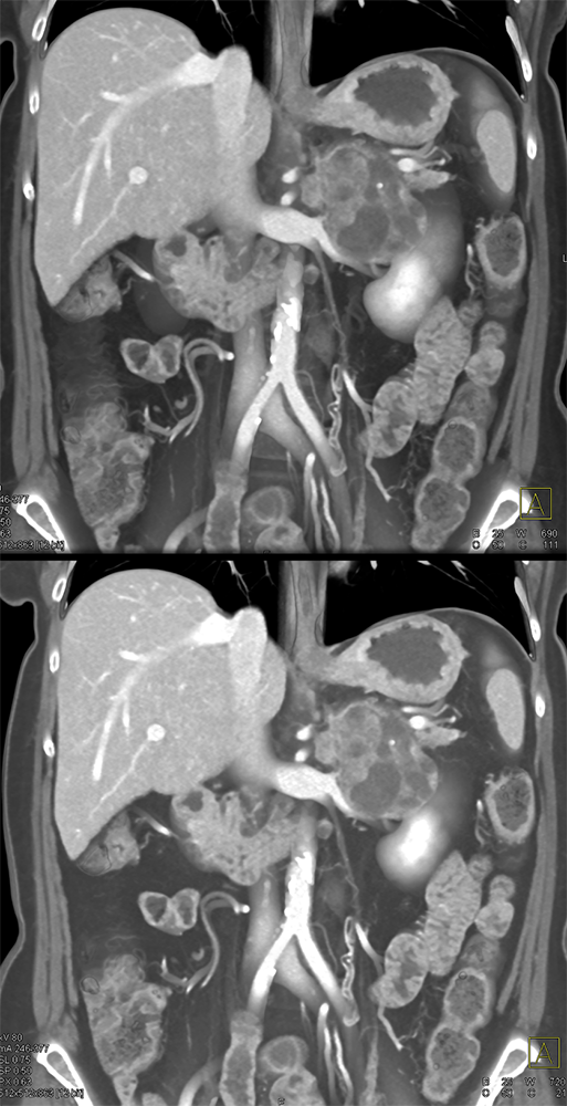 Large Adrenal Masses