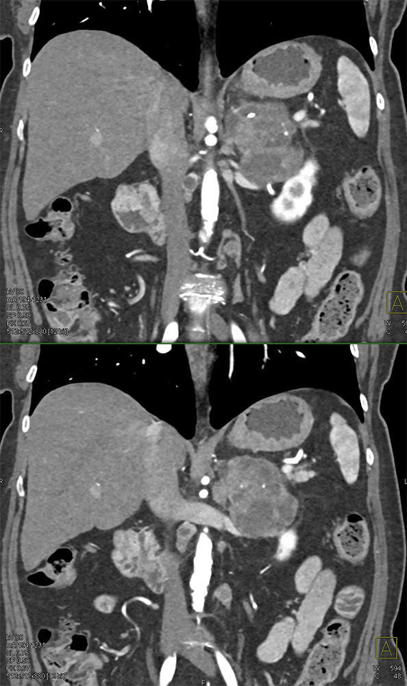 Large Adrenal Masses