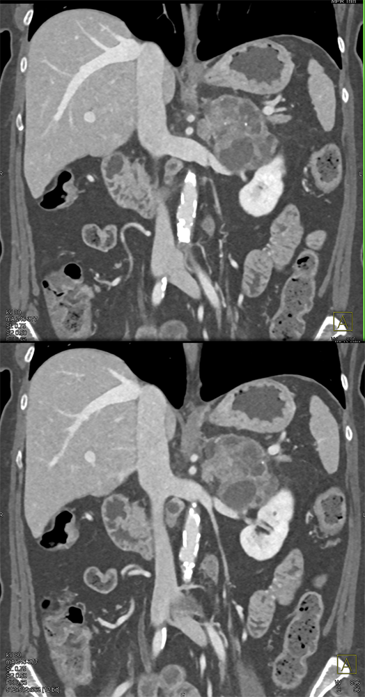 Large Adrenal Masses