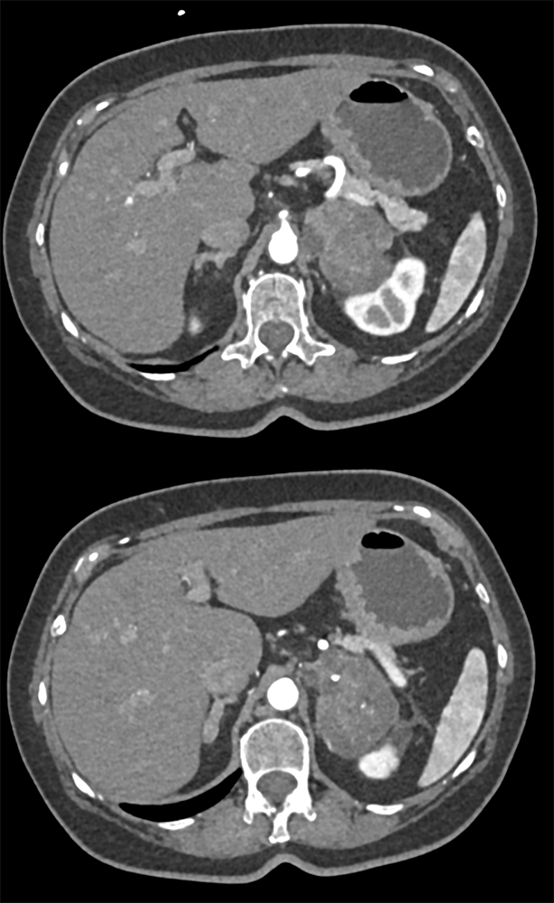 Metastatic Breast Cancer with Neuroendocrine Differentiation