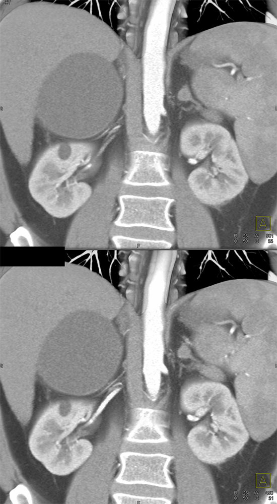 Large Adrenal Masses