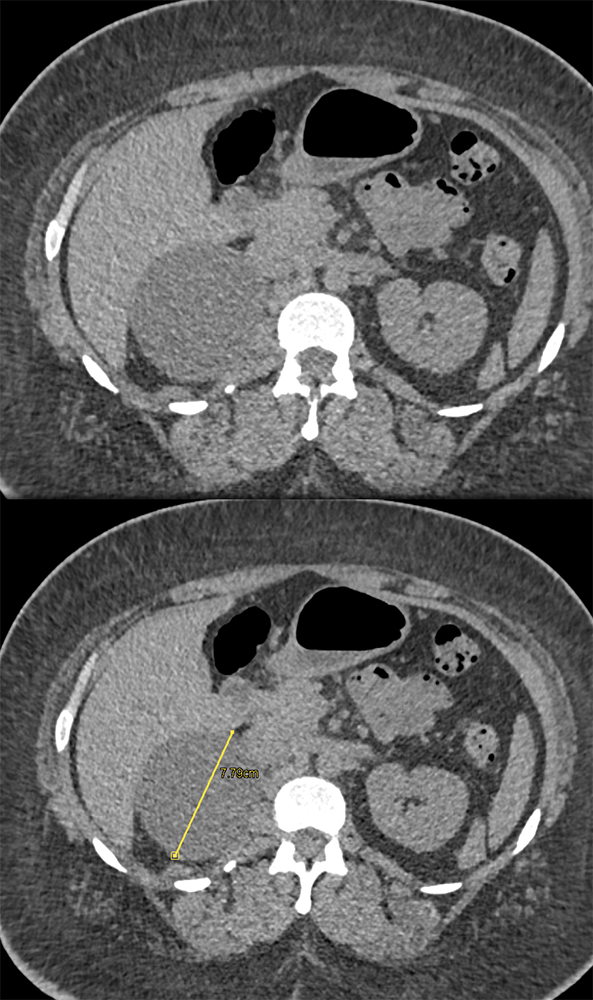 Adrenal Cyst