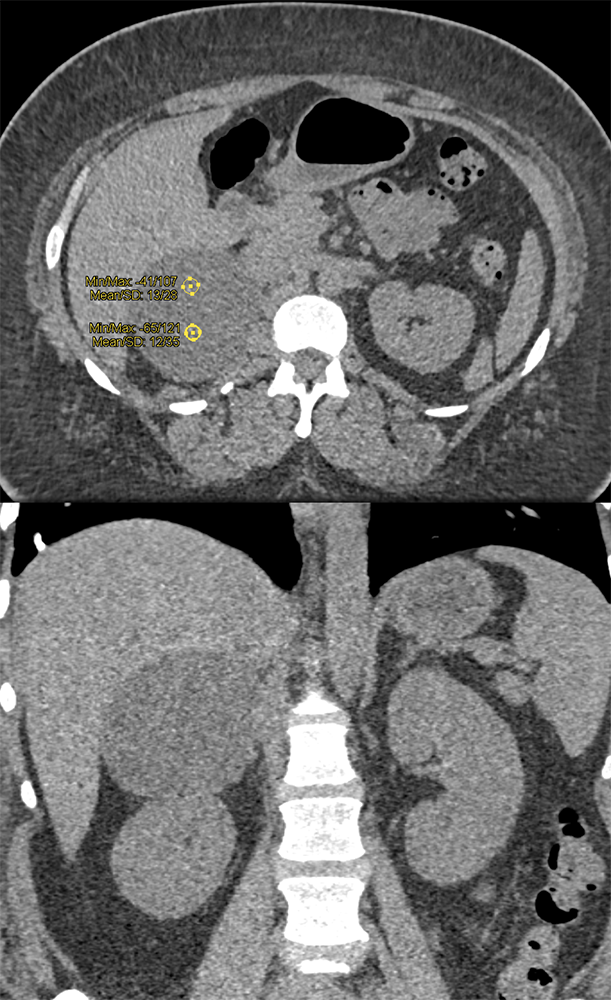 Large Adrenal Masses