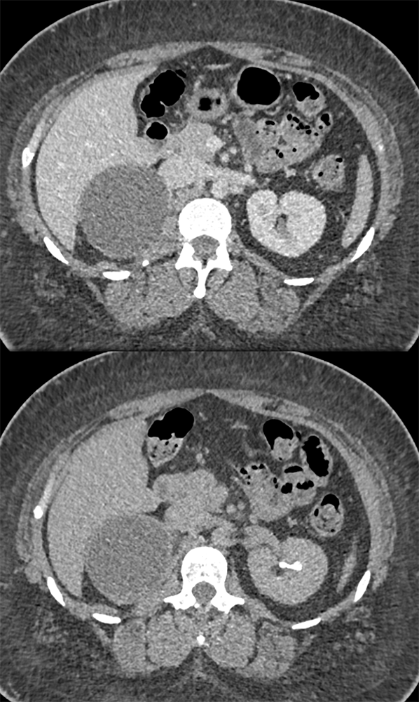 Large Adrenal Masses