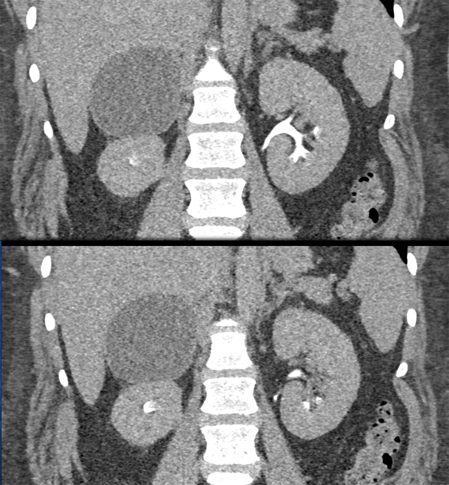 Large Adrenal Masses