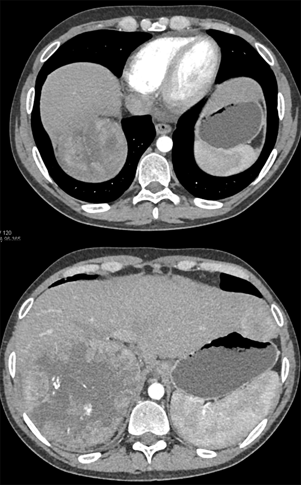 Primary Adrenal Cortical Carcinoma