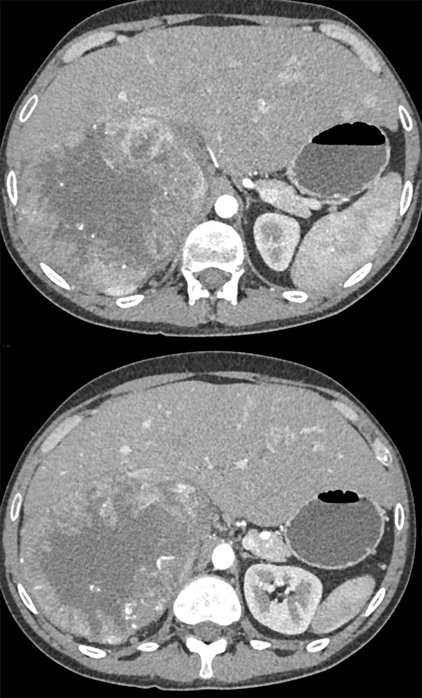 Large Adrenal Masses