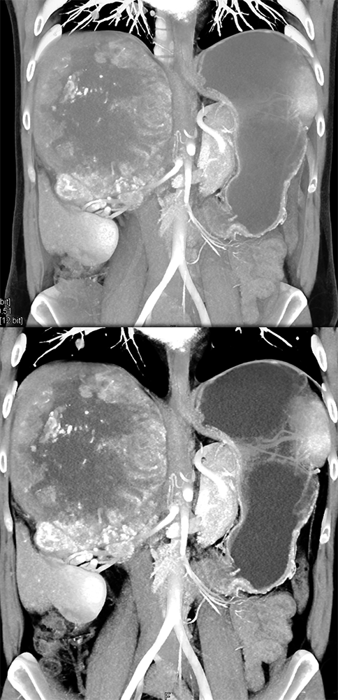 Large Adrenal Masses