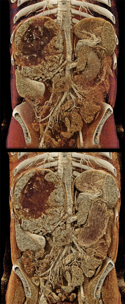 Large Adrenal Masses