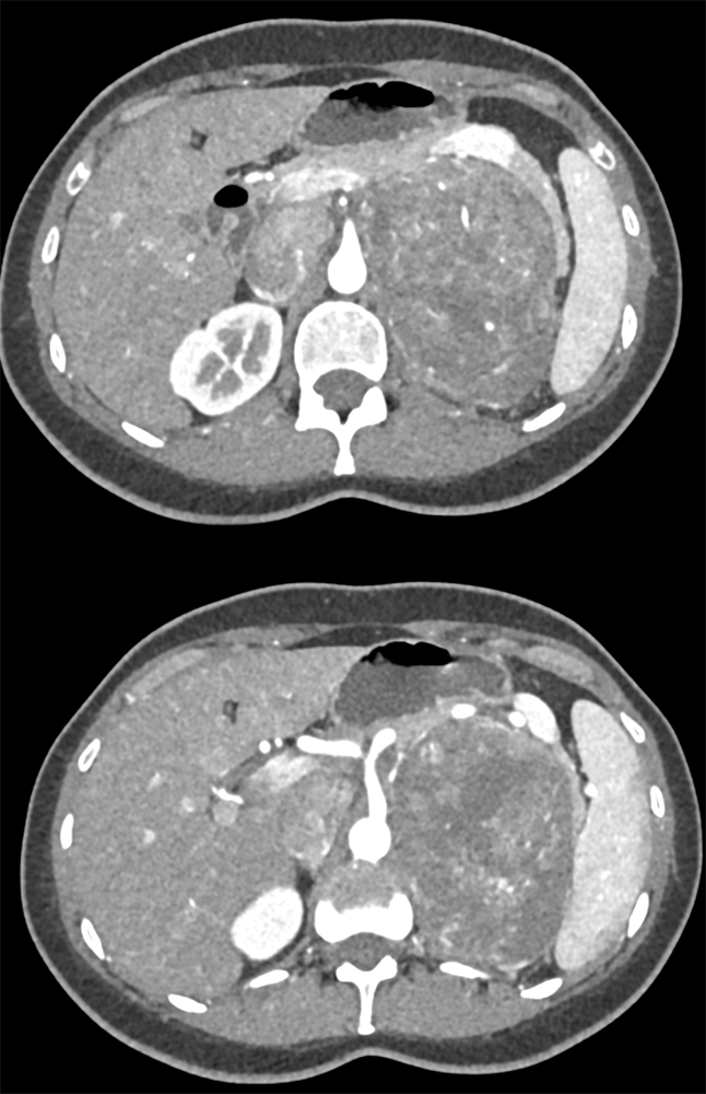 Incidental Finding on r/o PE Study