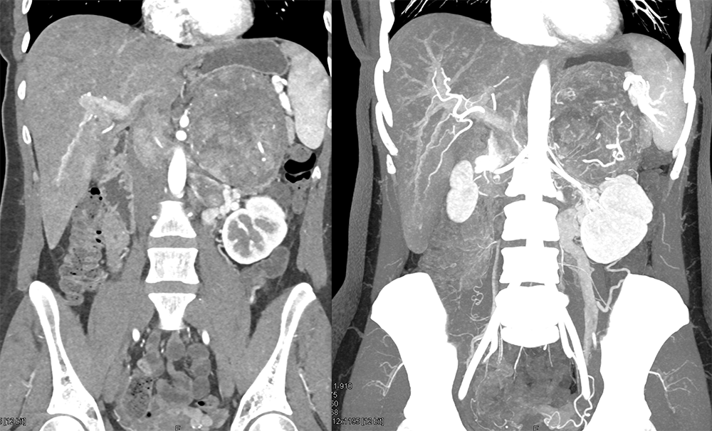 Large Adrenal Masses