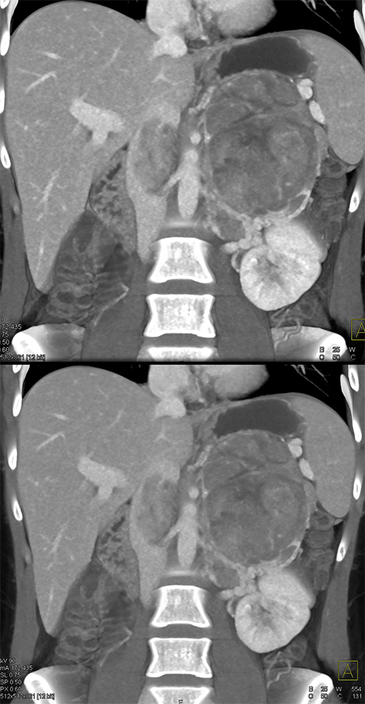 Large Adrenal Masses