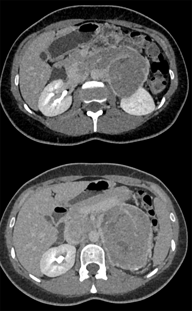 Large Adrenal Masses