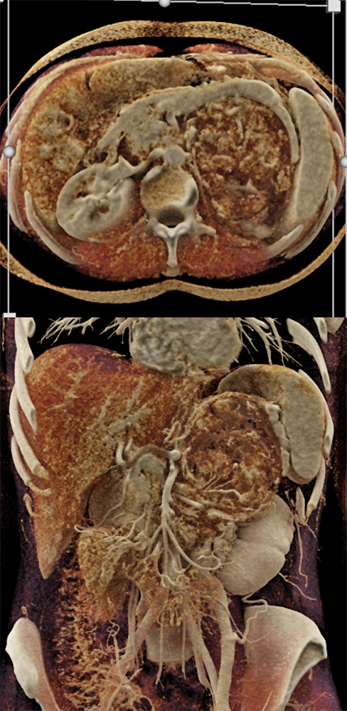 Large Adrenal Masses