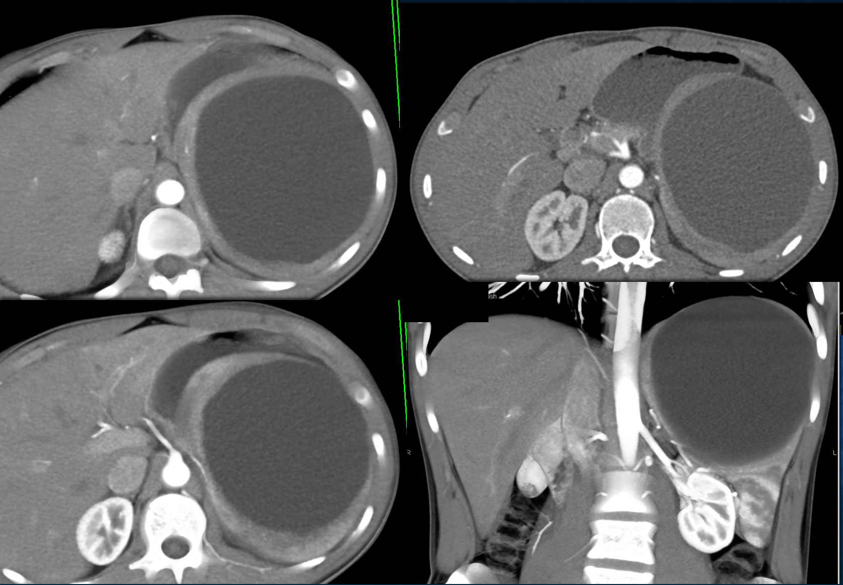 Simple Splenic Cyst on Path