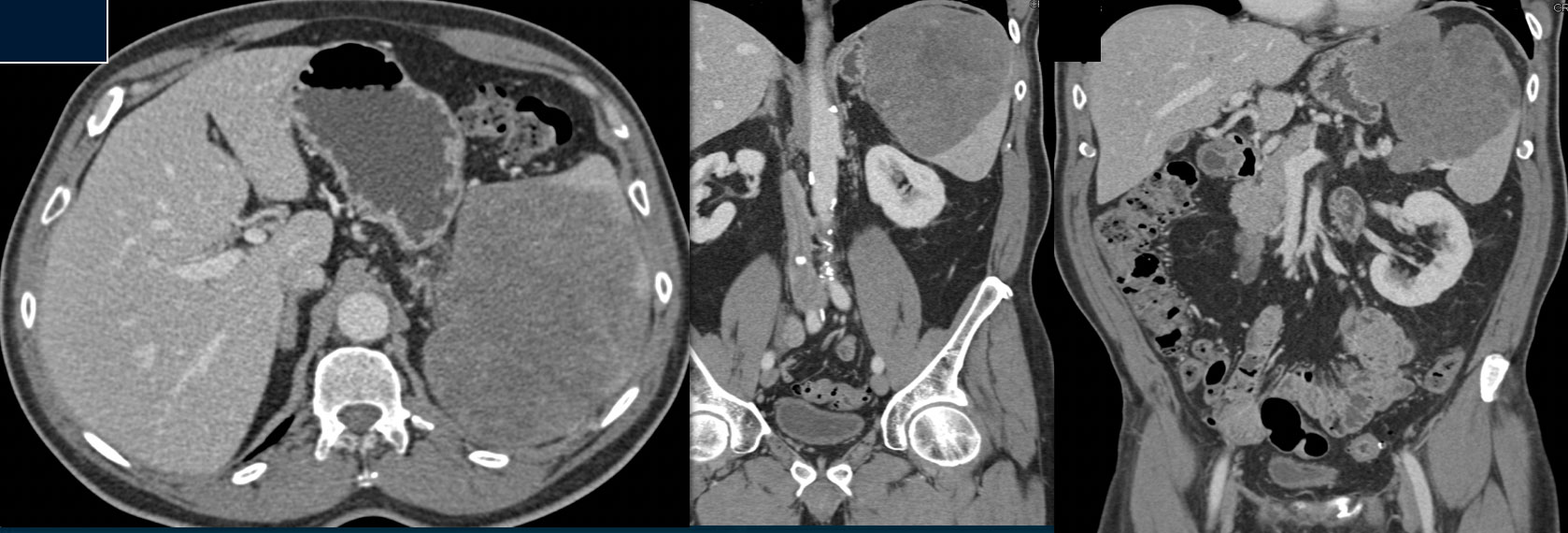 Primary Splenic Lymphoma