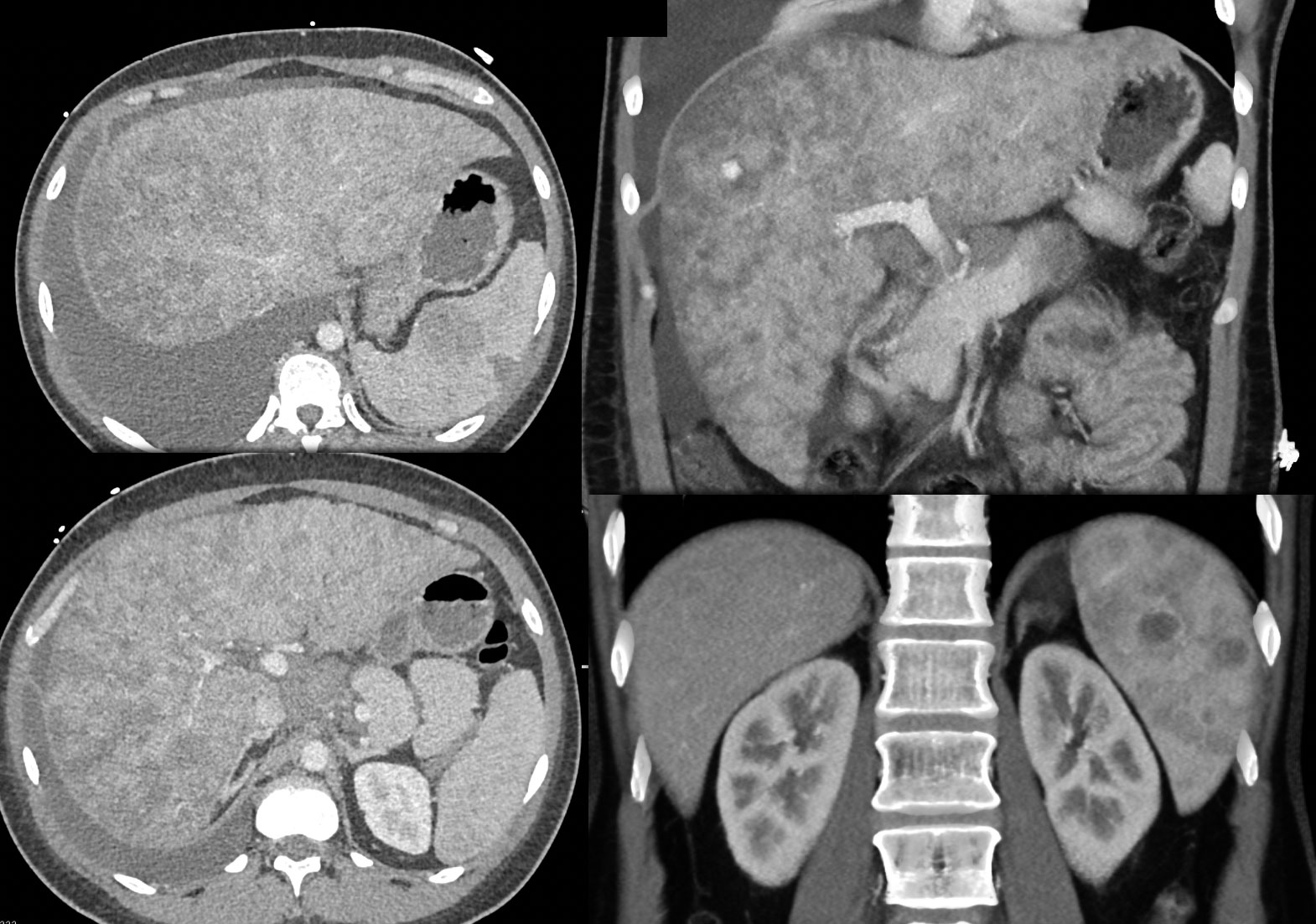 B-Cell Lymphoma