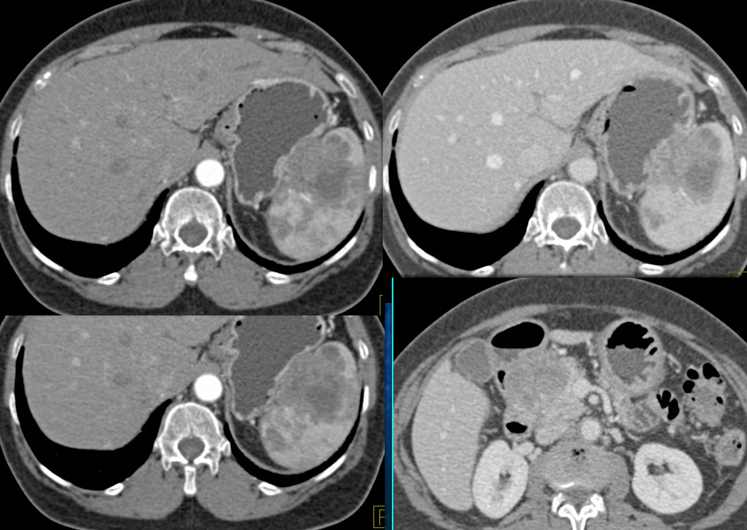 Pancreatic and Splenic Lymphoma