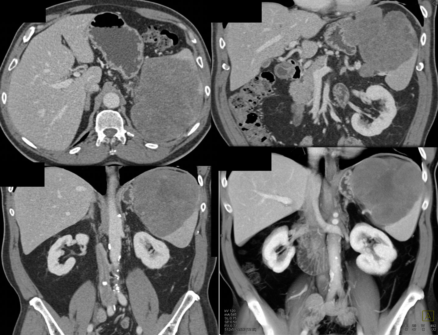 Primary Splenic Lymphoma