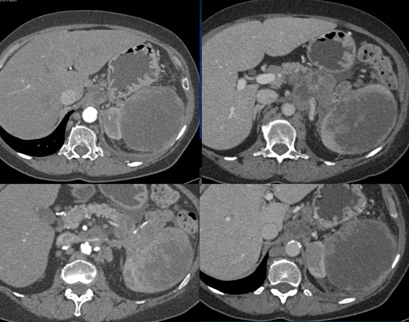 Diffuse Large B-Cell Lymphoma