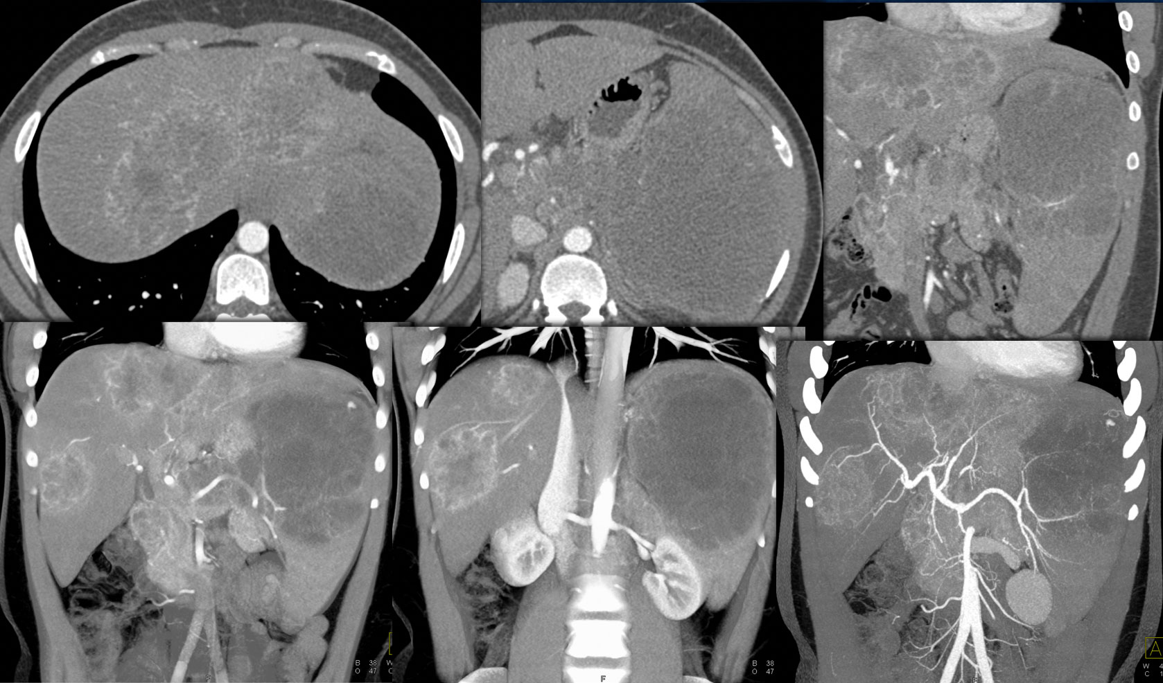 Diffuse Large B-Cell Lymphoma