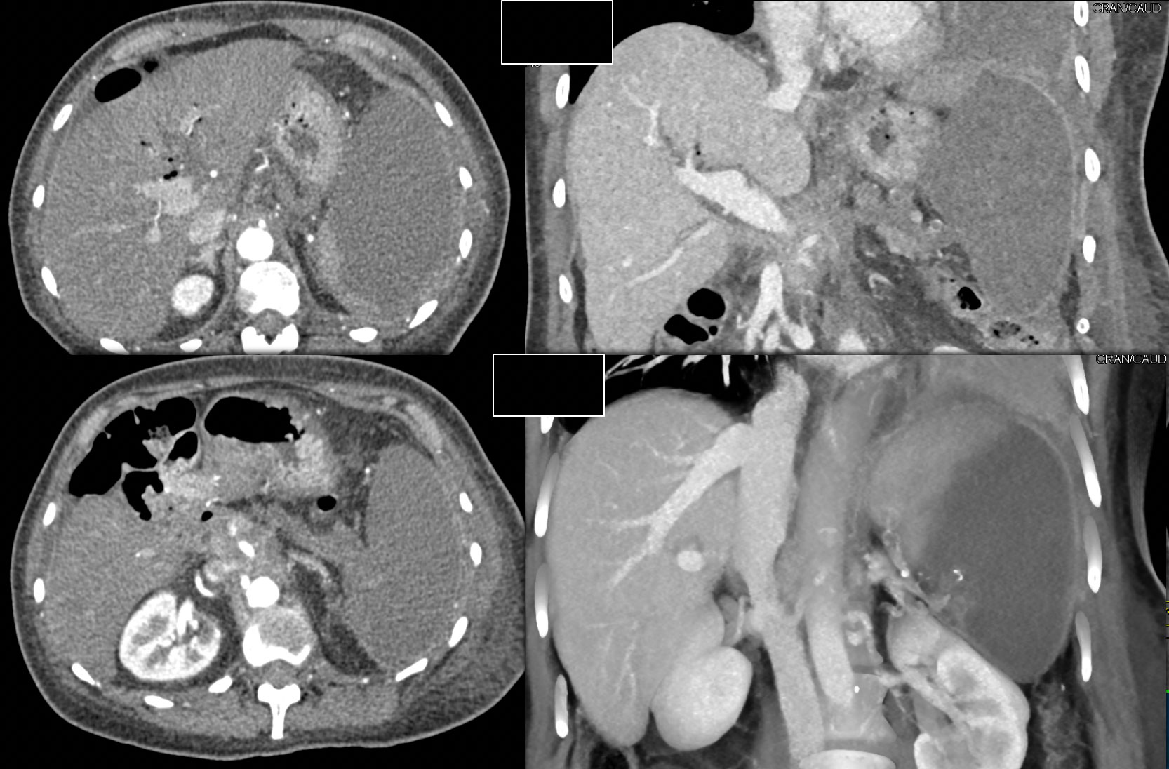 Infarcted Spleen s/p Whipples