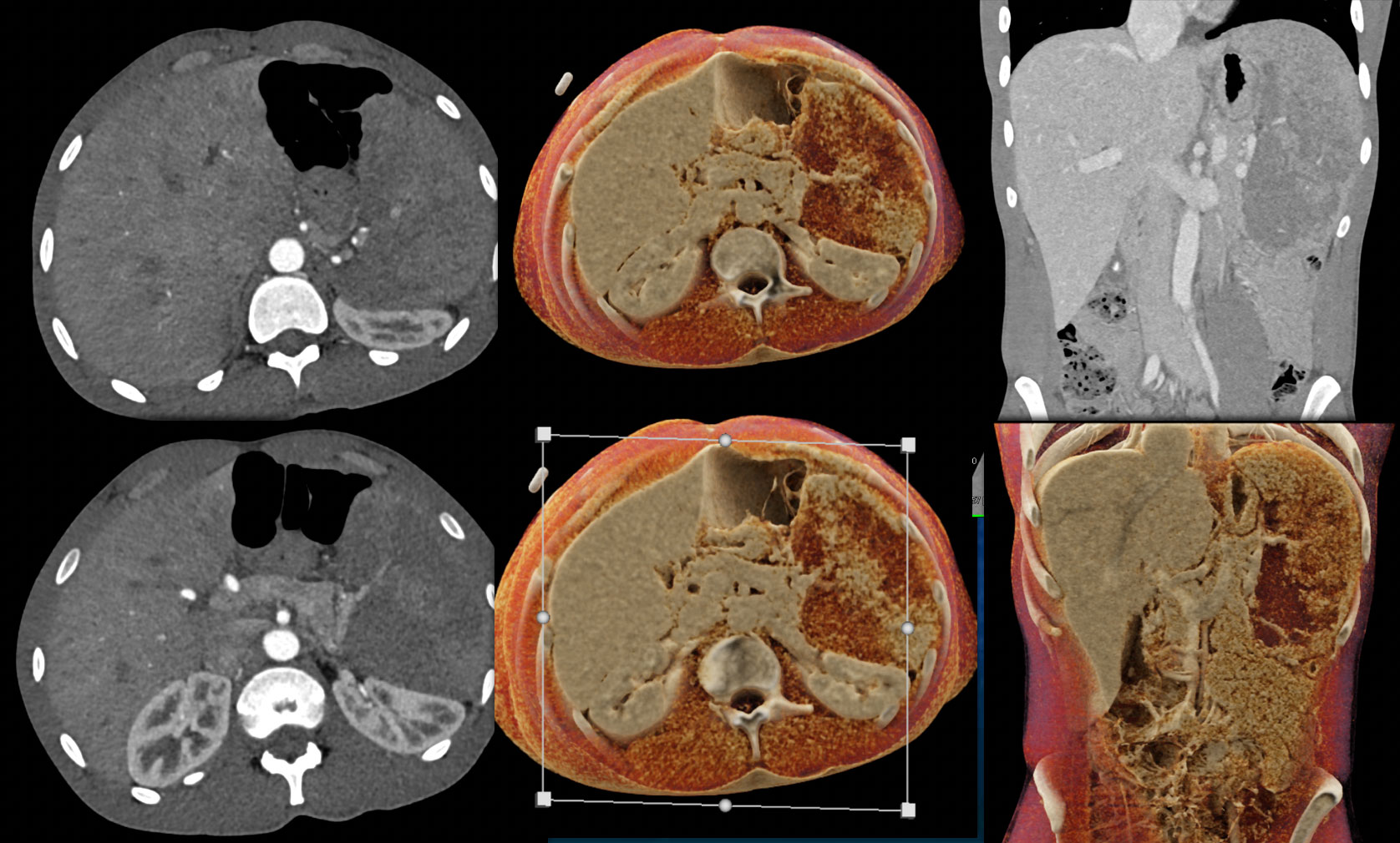 Infarcted Spleen s/p Whipples