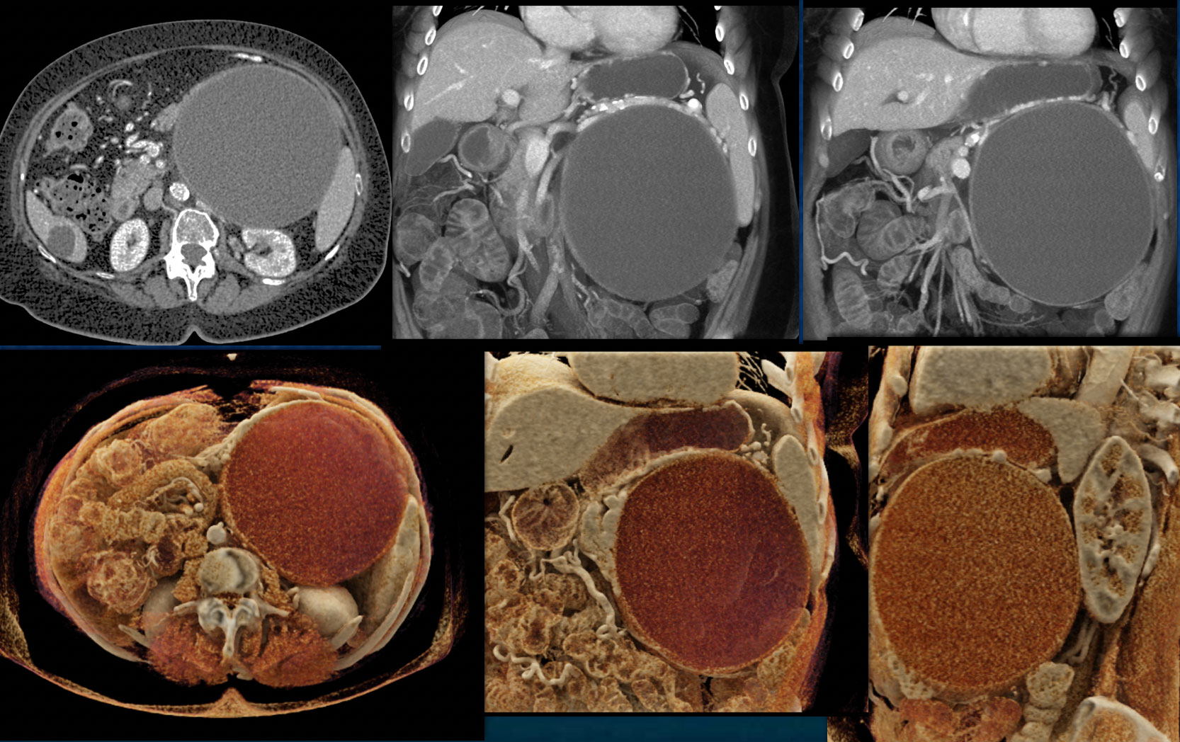 Epithelial Cyst Spleen Compresses Tail of Pancreas