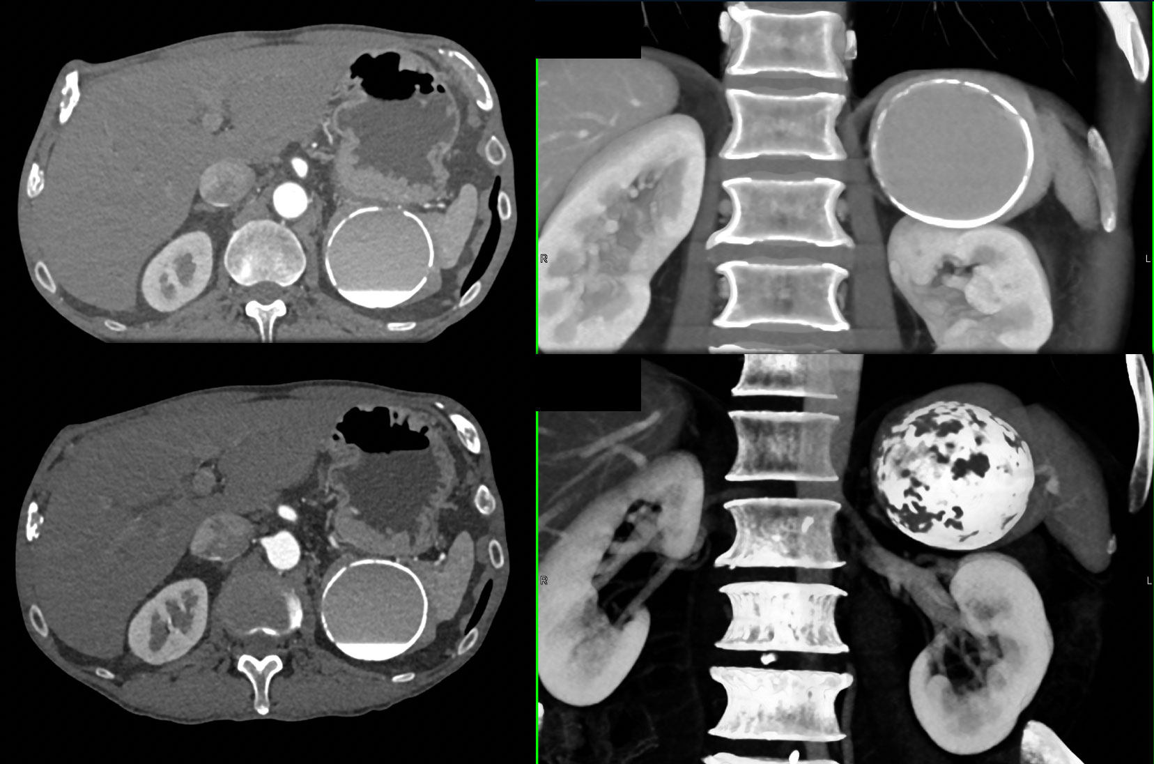 Calcified Cyst Spleen