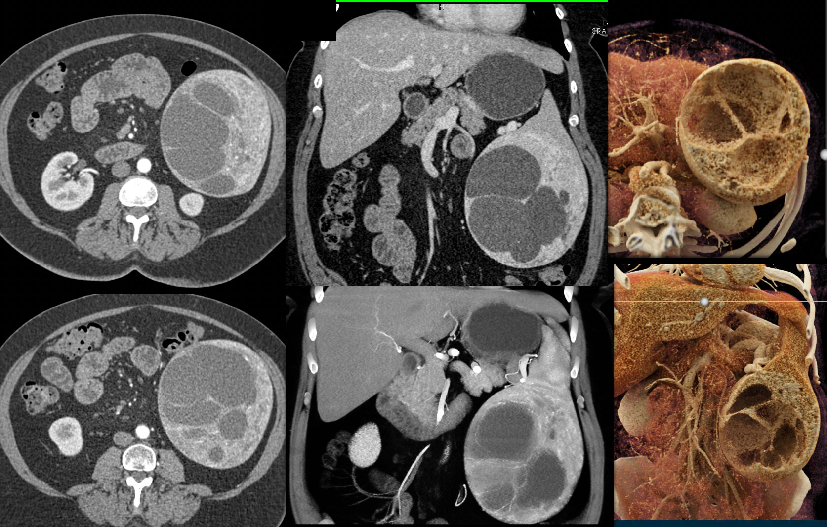 Vascular Mass with EMH and Areas of Hemorrhage/Necrosis