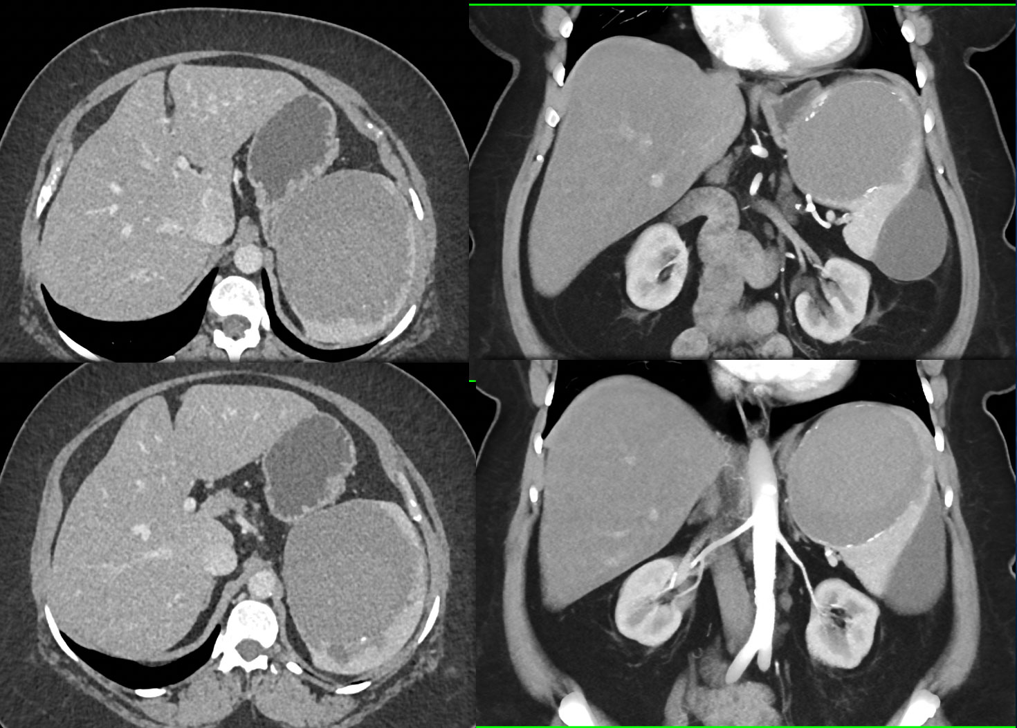 old hematoma with faint calcifications