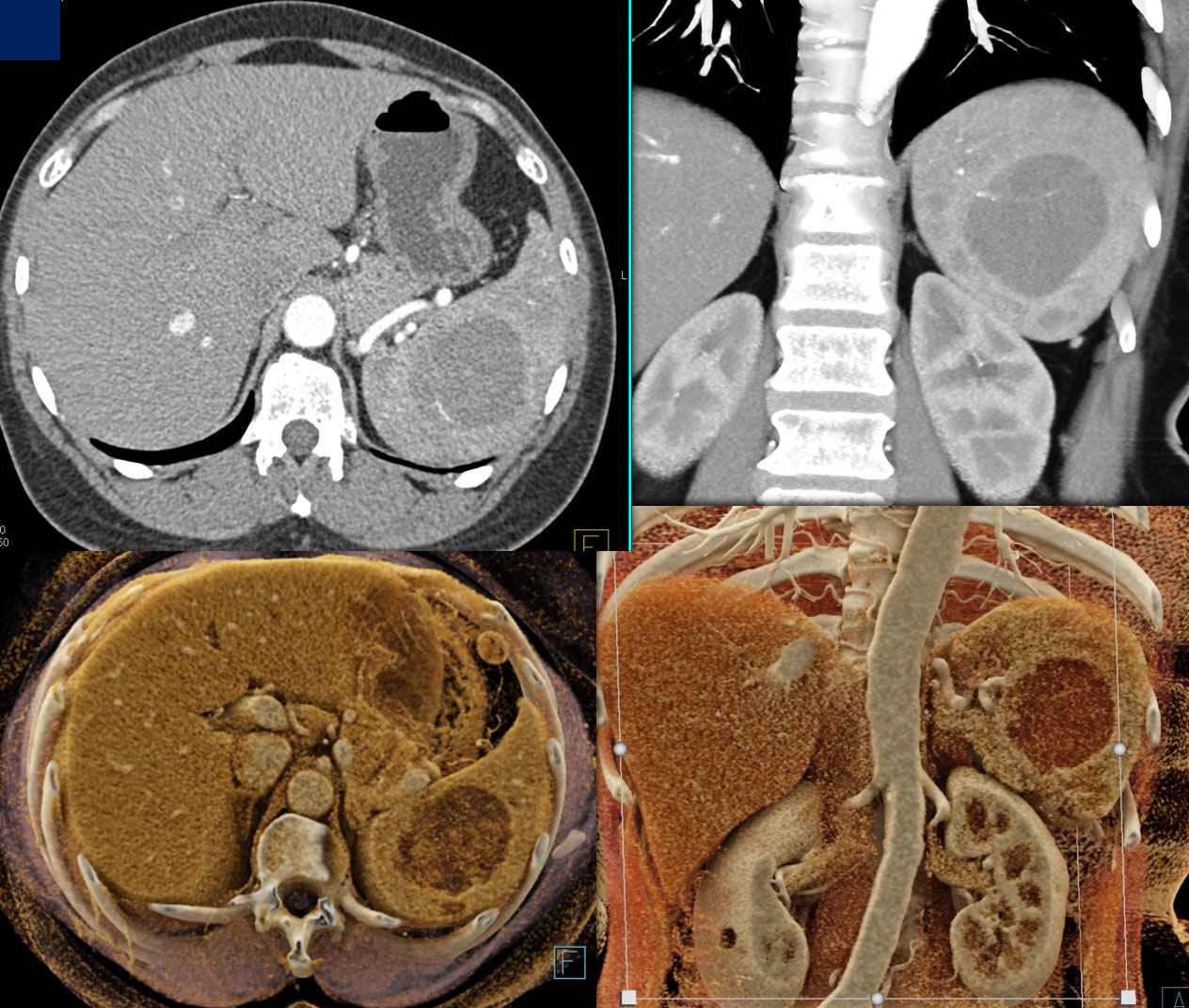 Splenic  Hemangioma