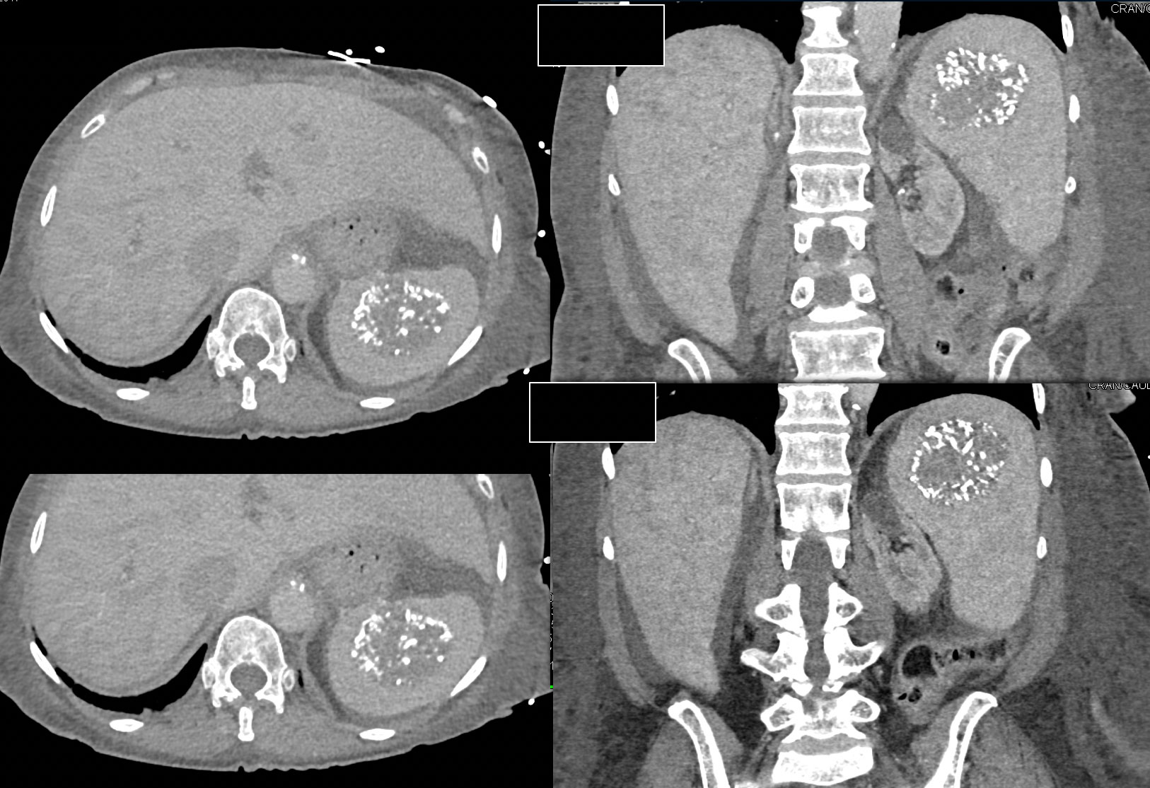 Splenic  Hemangioma