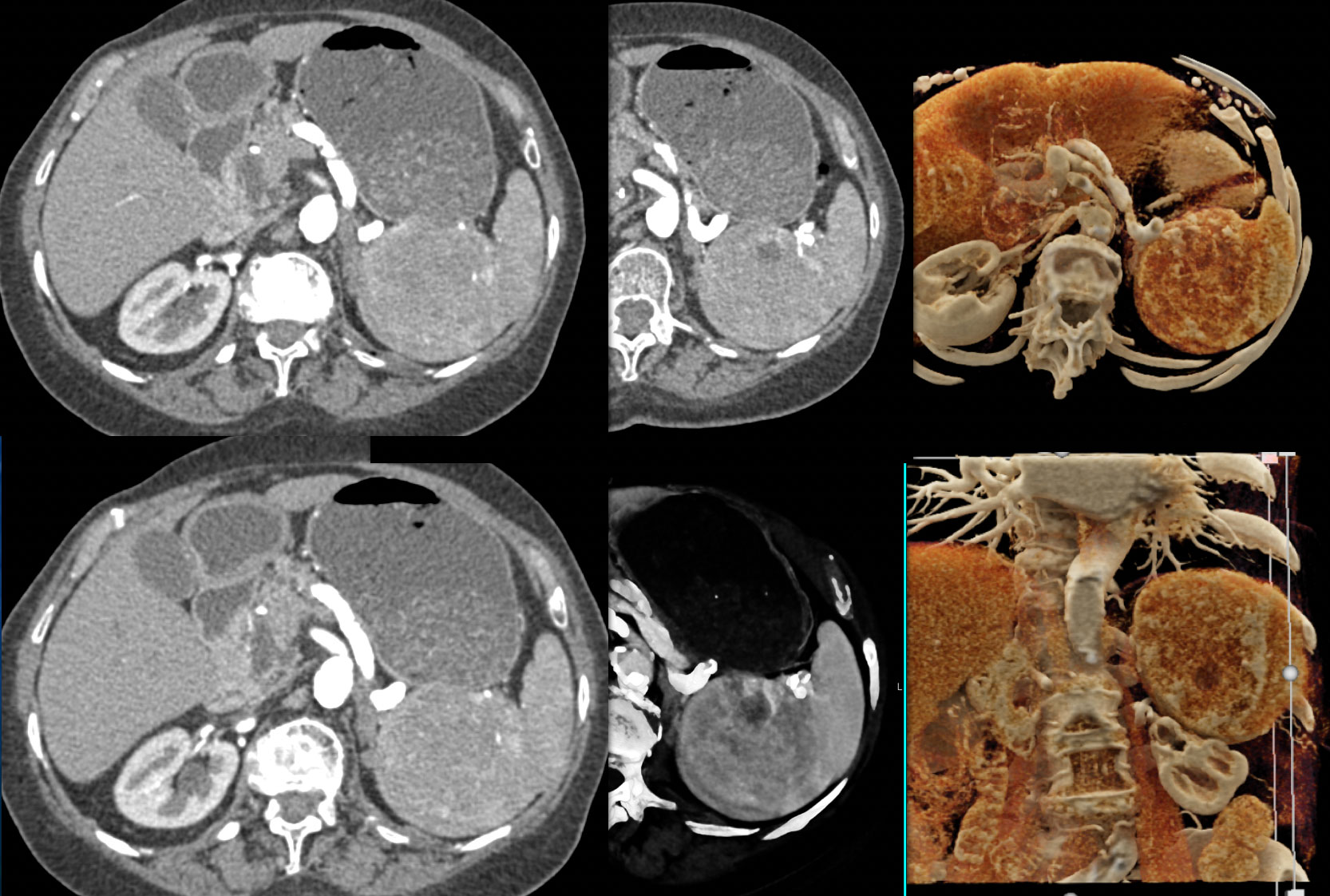 Splenic Hamartoma