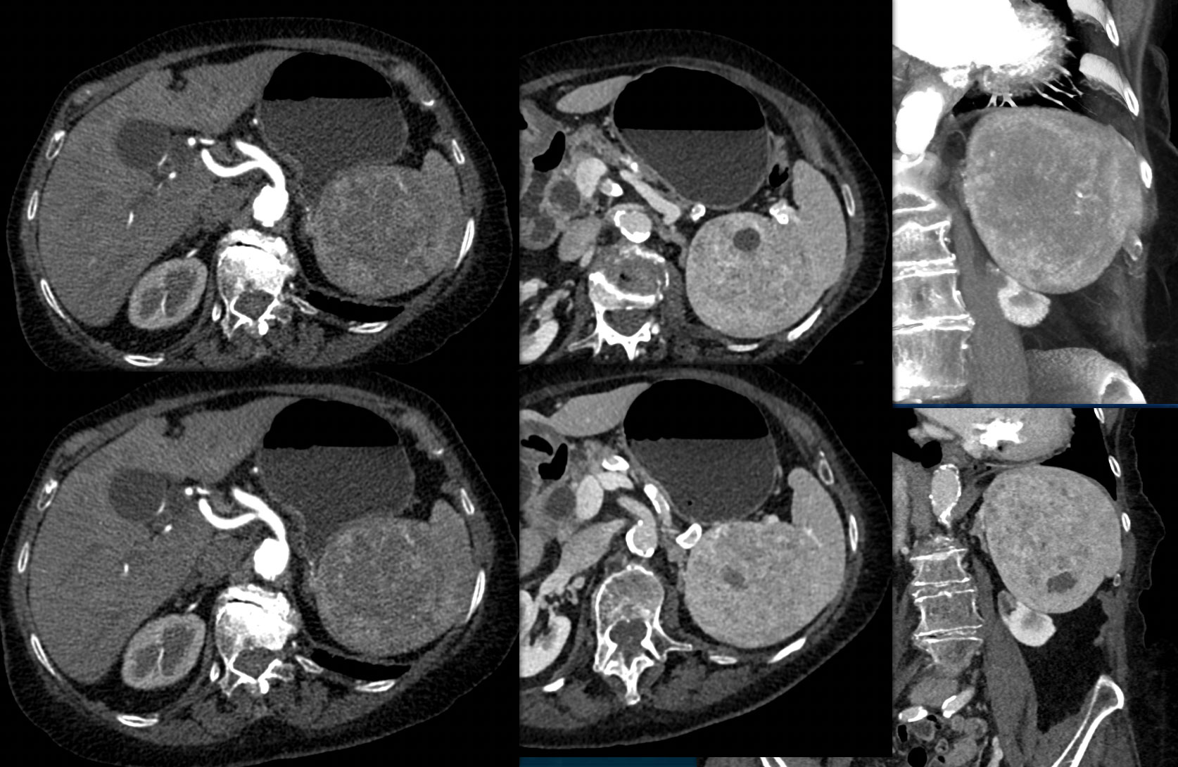 Splenic Hamartoma