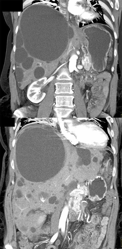 CT of Liver Masses