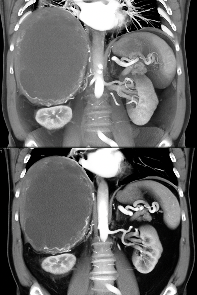 CT of Liver Masses