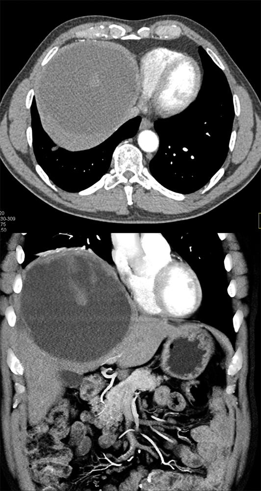 Small Bowel GIST Tumor Metastatic to the Liver