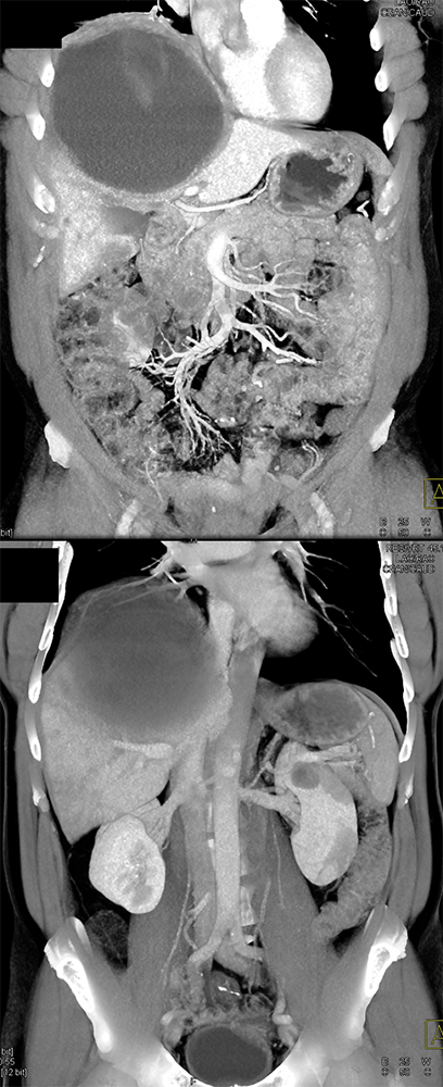 CT of Liver Masses