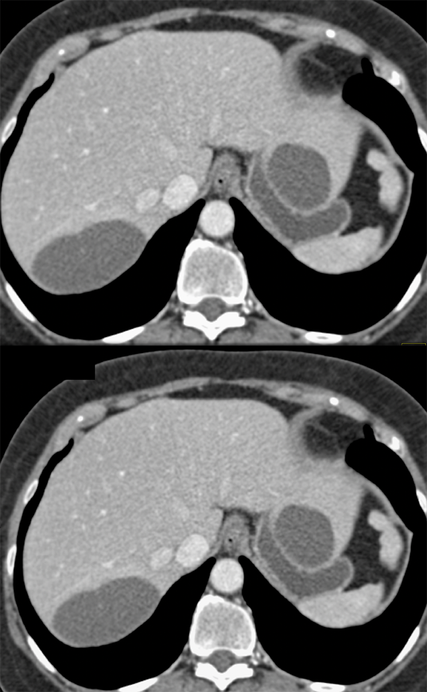 Liver Cysts