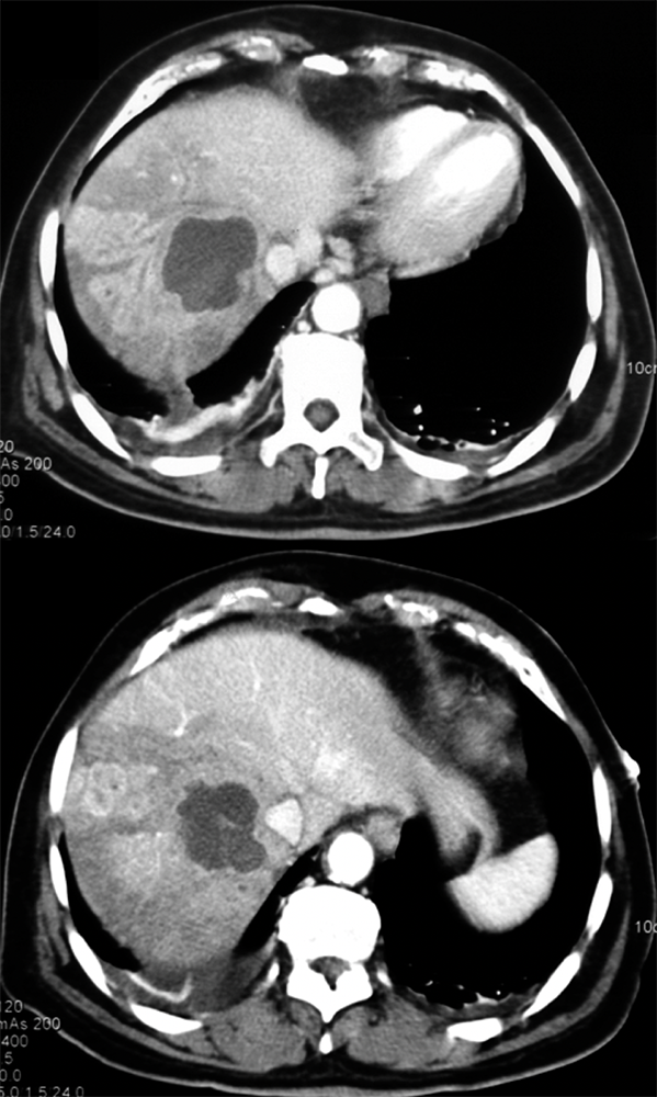 Liver Abscess